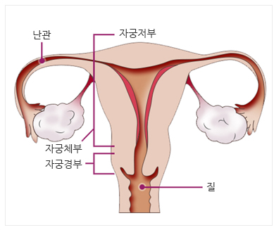 자궁경부암